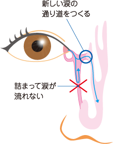 図③ 涙嚢鼻腔吻合術